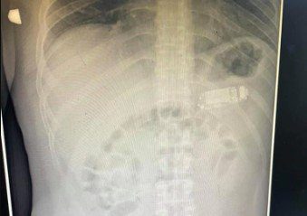 Se tragó un celular Nokia 3310 y tuvieron que operarlo para salvarle la vida Se tragó un celular Nokia 3310 y tuvieron que operarlo para salvarle la vida